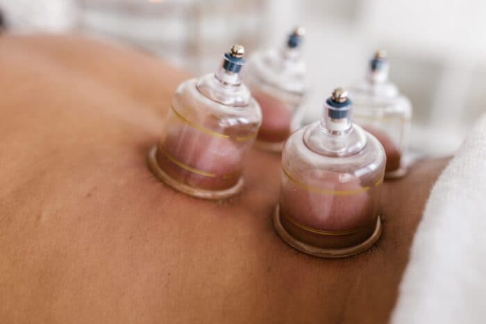 Cupping Therapy